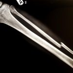 Broken Bone Injury Lawyer