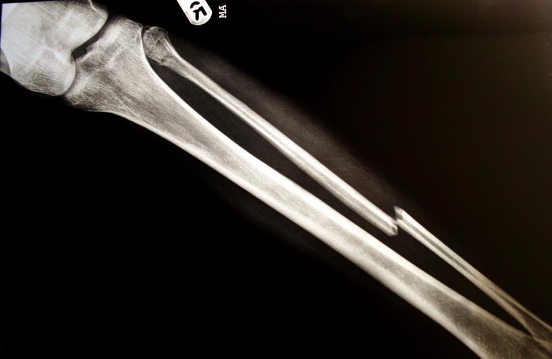 Broken Bone Injury Lawyer