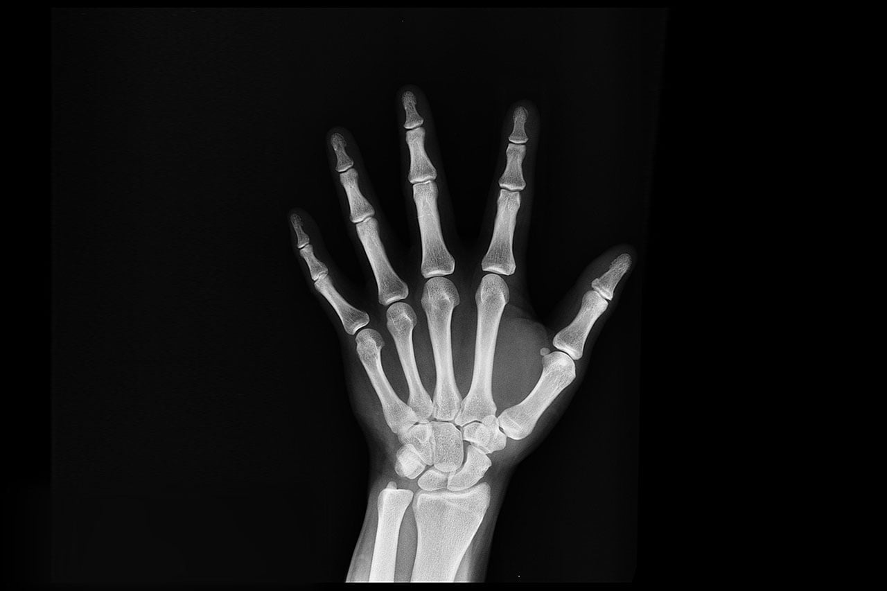 What Are the Consequences of Delaying Bone Fracture Treatment